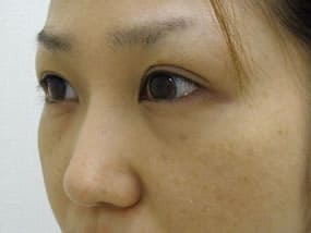 目の下のクマ・タルミ症例手術前