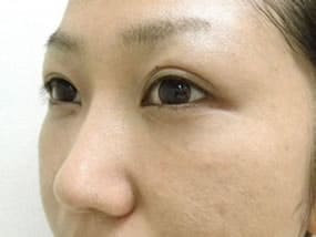 目の下のクマ・タルミ症例手術３ヶ月後