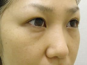 目の下のクマ・タルミ症例手術前