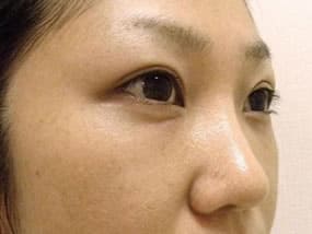 目の下のクマ・タルミ症例手術３ヶ月後