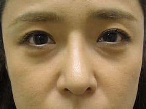 目の下のクマ・タルミ症例手術前
