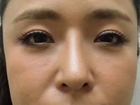 目の下のクマ・タルミ症例手術３ヶ月後