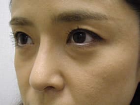 目の下のクマ・タルミ症例手術前