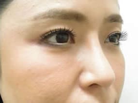 目の下のクマ・タルミ症例手術３ヶ月後