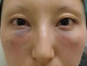 目の下のクマ・タルミ症例手術直後（メイクなし）