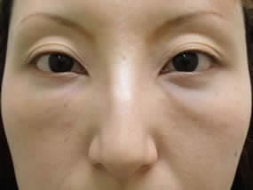 目の下のクマ・タルミ症例手術１週間後（メイクあり）