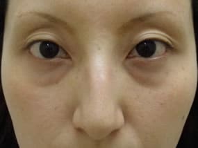 目の下のクマ・タルミ症例手術前