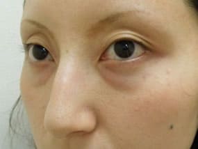 目の下のクマ・タルミ症例手術前