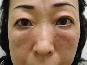 目の下のクマ・タルミ症例手術直後（メイクなし）