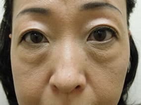 目の下のクマ・タルミ症例手術前
