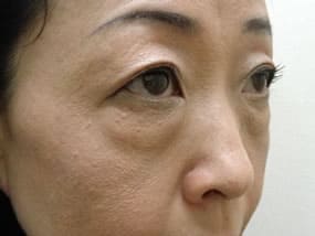 目の下のクマ・タルミ症例手術前