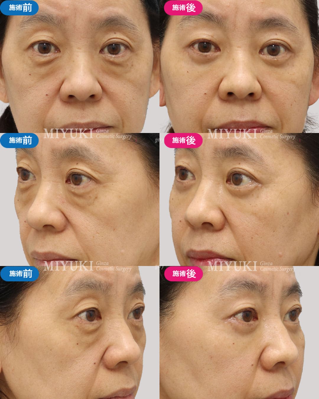 目の下のくま症例430の治療画像