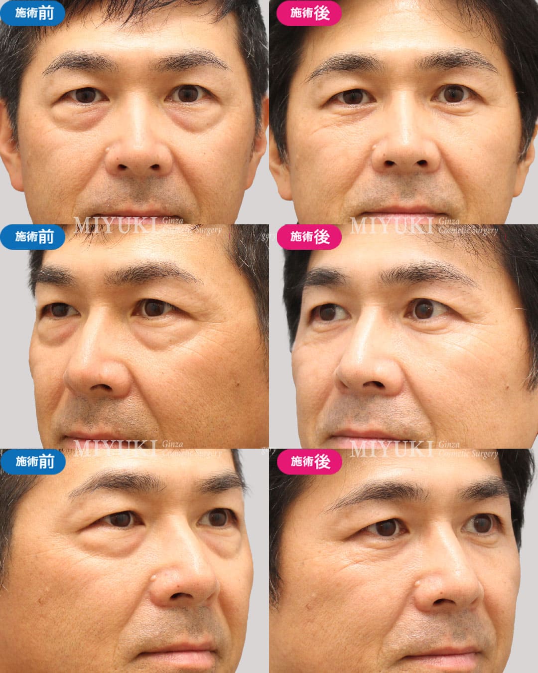 目の下のくま症例431の治療画像