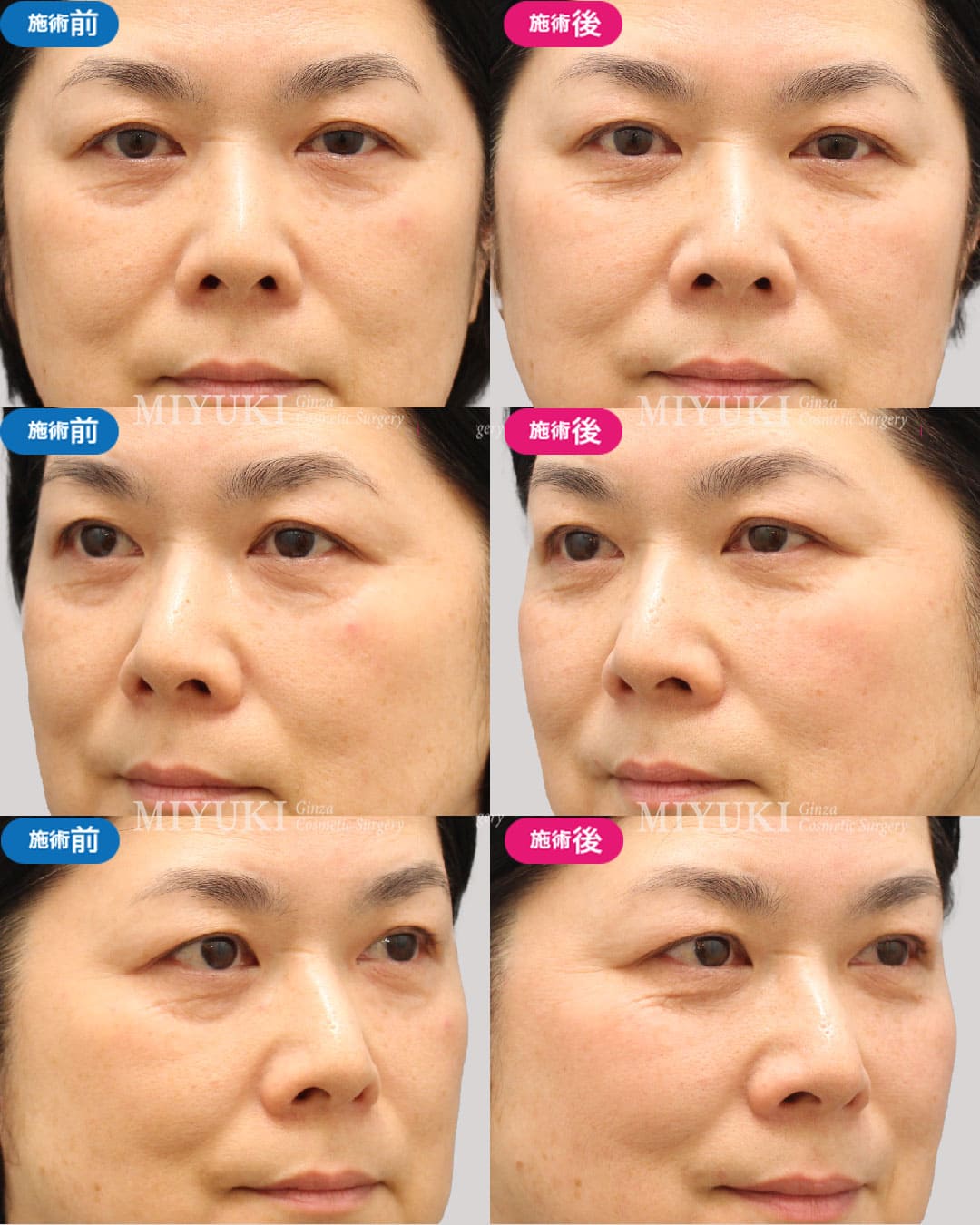 目の下のくま症例439の治療画像