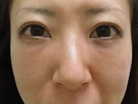 目の下のクマ・タルミ症例手術２週間後（メイクあり）