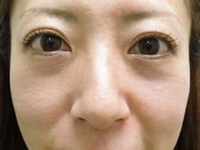 目の下のクマ・タルミ症例手術前