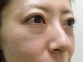 目の下のクマ・タルミ症例手術前