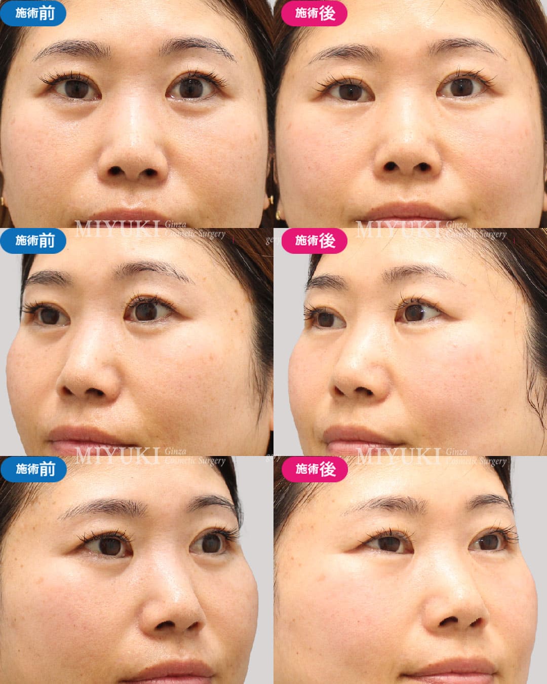 目の下のくま症例442の治療画像