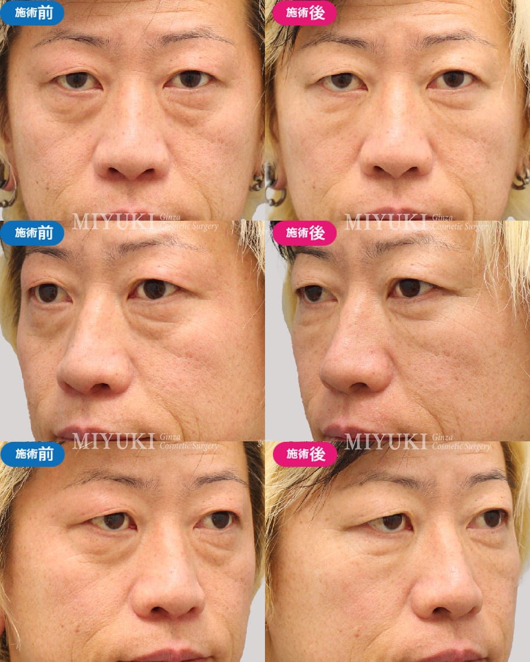 目の下のくま症例443の治療画像