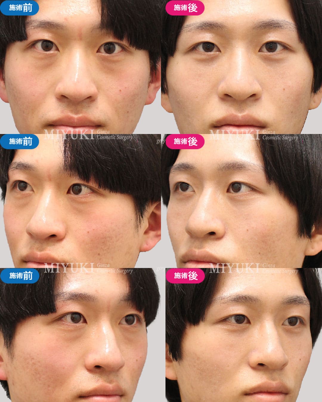 目の下のくま症例447の治療画像