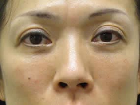 目の下のクマ・タルミ症例手術３ヶ月後