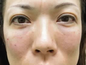 目の下のクマ・タルミ症例手術直後（メイクなし）