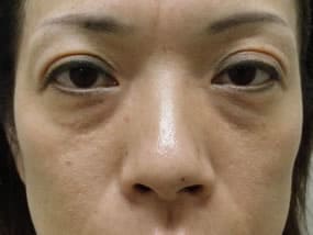 目の下のクマ・タルミ症例手術前