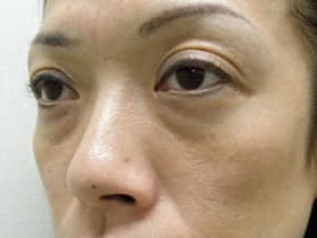 目の下のクマ・タルミ症例手術前