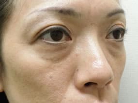 目の下のクマ・タルミ症例手術前