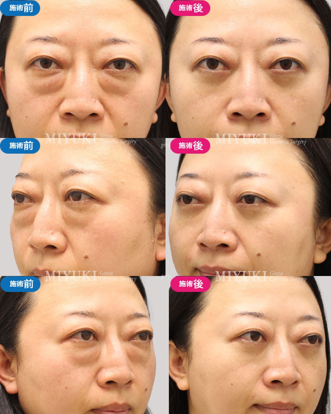 目の下のくま症例450の治療画像