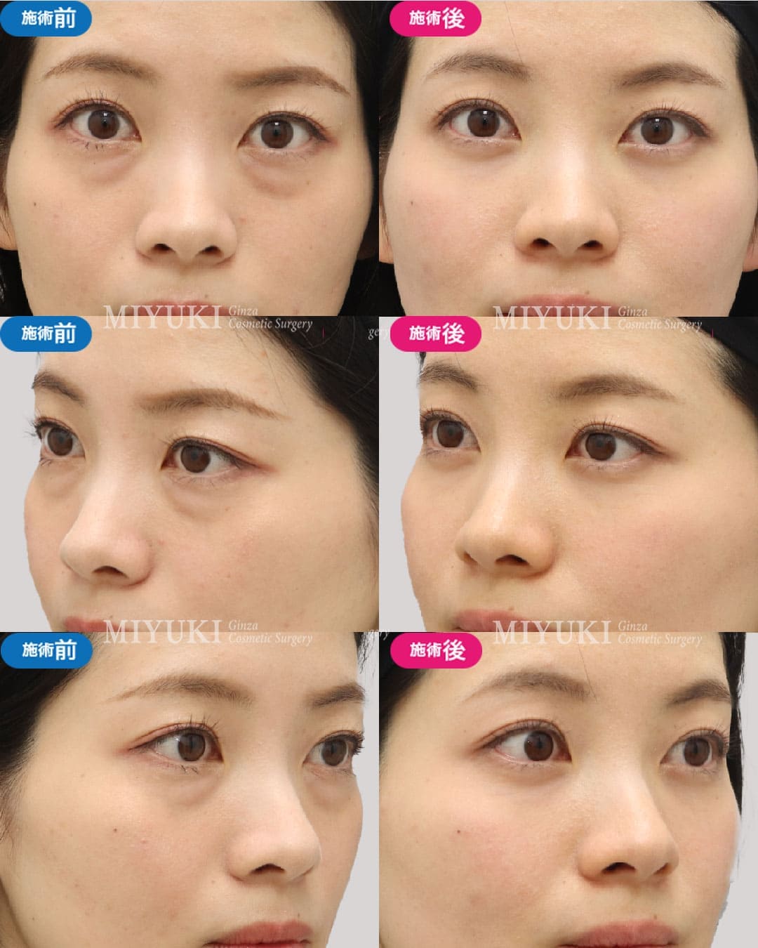 目の下のくま症例452の治療画像