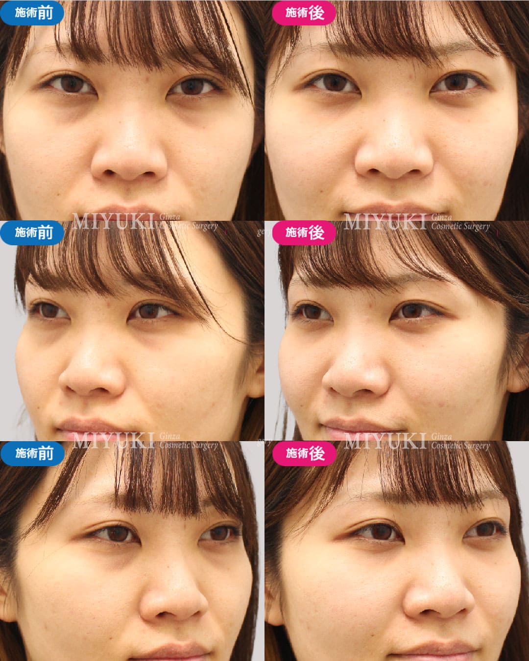 目の下のくま症例454の治療画像