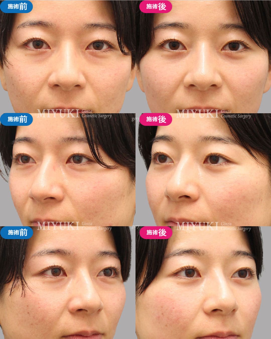 目の下のくま症例455の治療画像