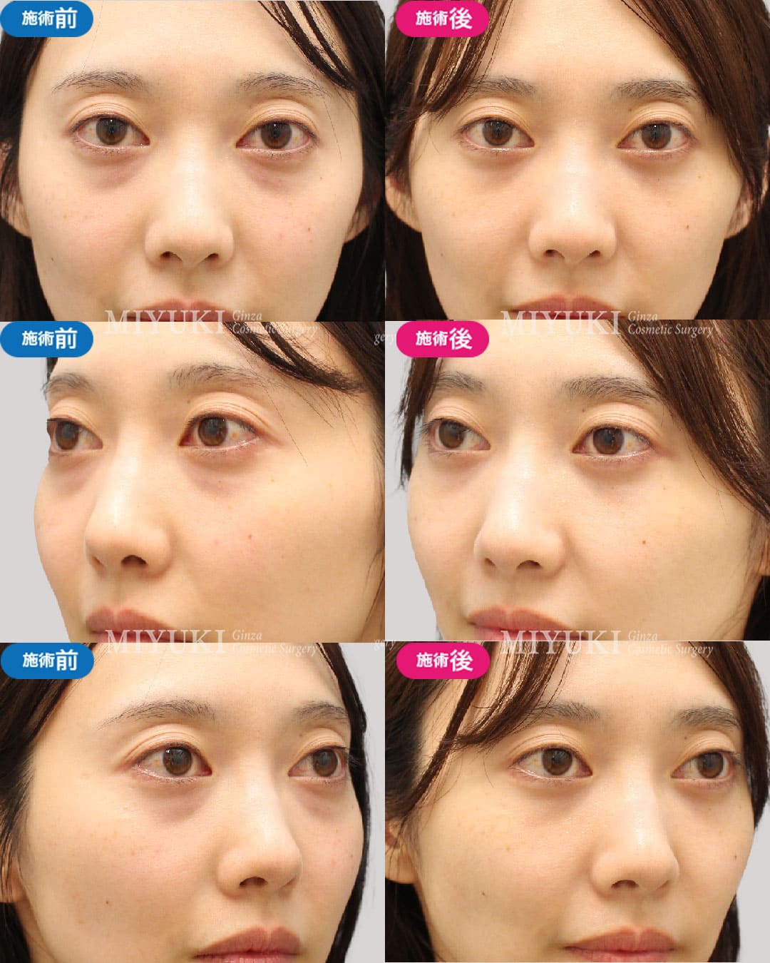 目の下のくま症例456の治療画像