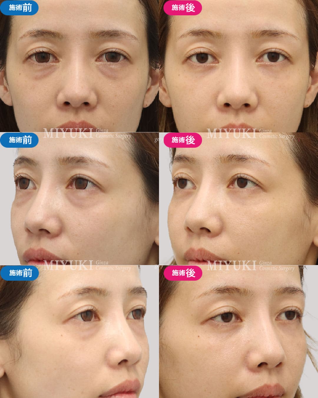 目の下のくま症例457の治療画像