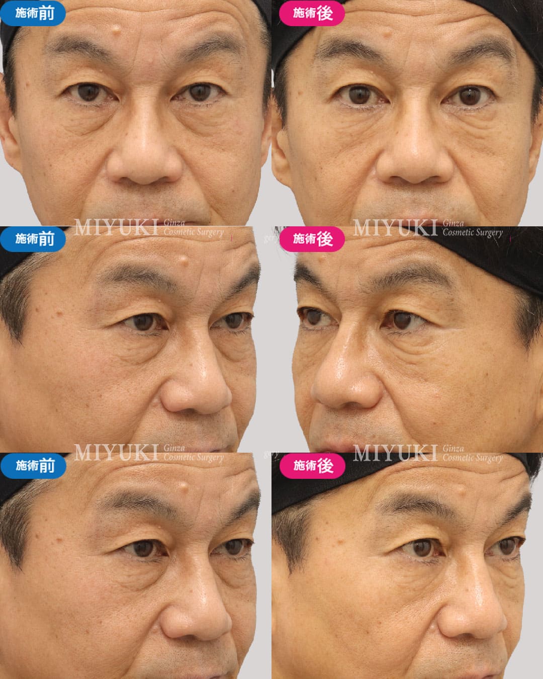 目の下のくま症例458の治療画像