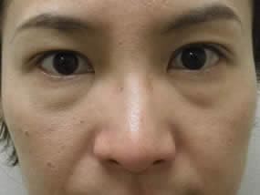 目の下のクマ・タルミ症例手術前（メイクあり）
