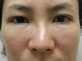 目の下のクマ・タルミ症例手術直後（メイクなし）