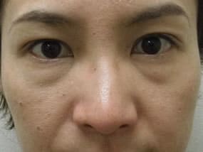 目の下のクマ・タルミ症例手術前