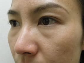 目の下のクマ・タルミ症例手術前