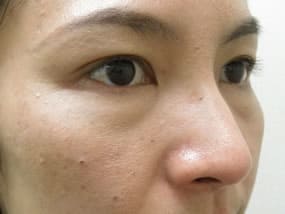 目の下のクマ・タルミ症例手術前