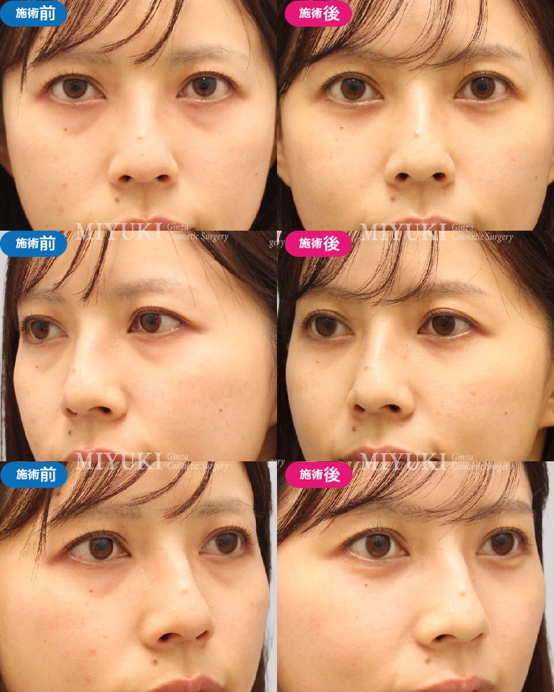 目の下のくま症例460の治療画像