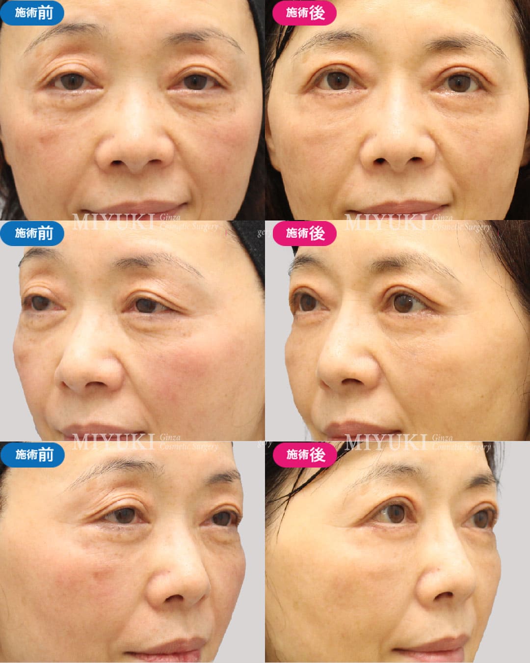 目の下のくま症例461の治療画像