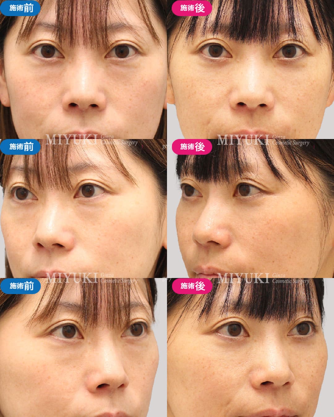 目の下のくま症例463の治療画像