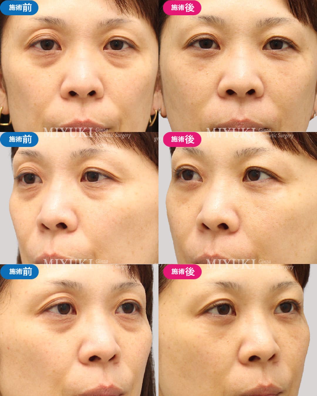 目の下のくま症例464の治療画像