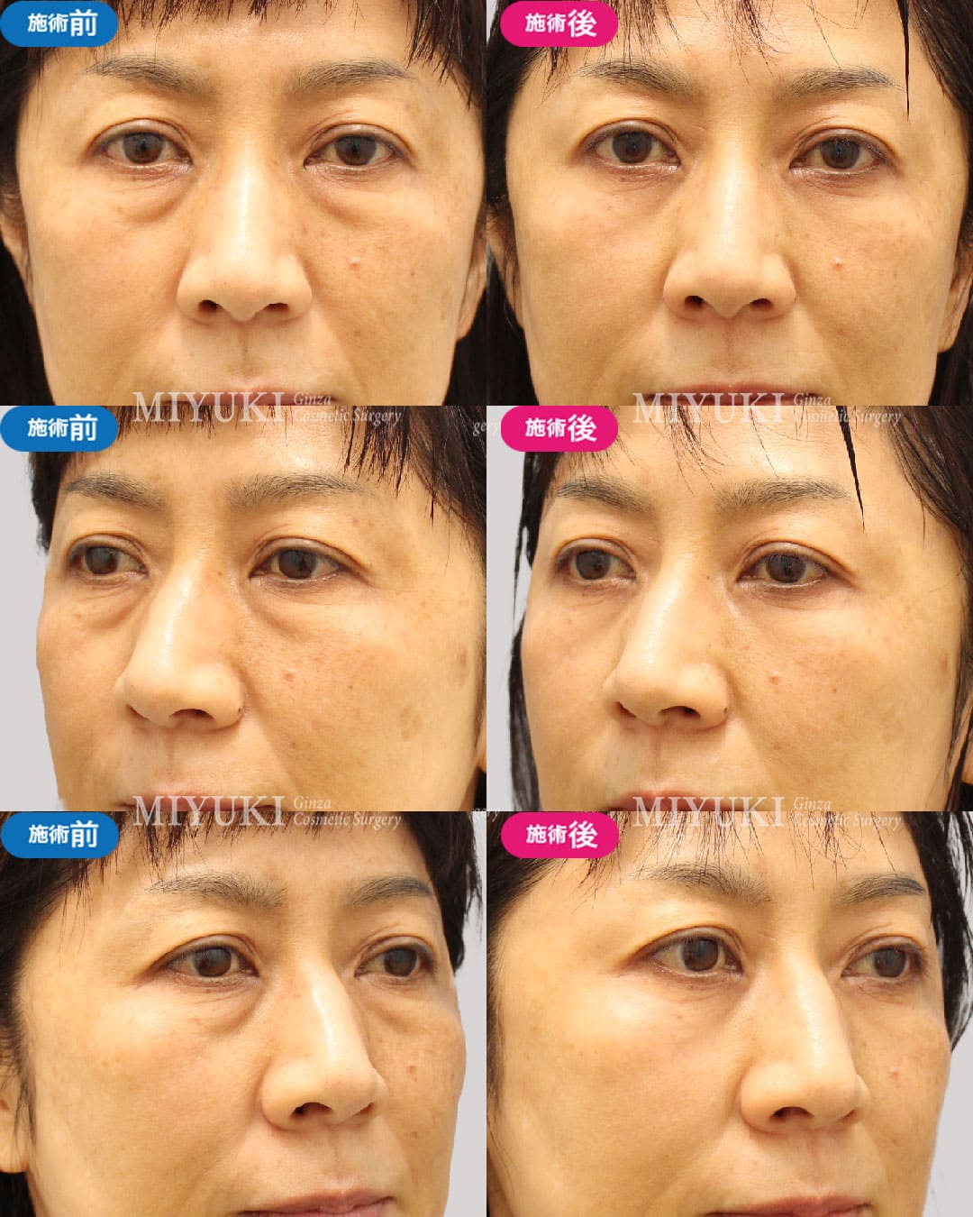 目の下のくま症例465の治療画像