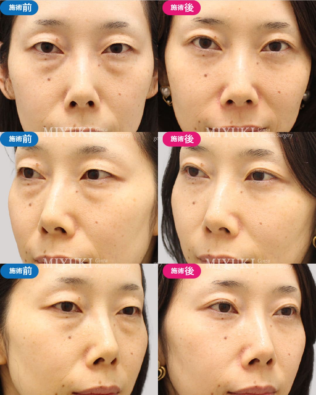 目の下のくま症例466の治療画像