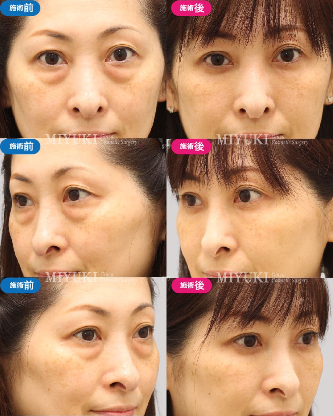 目の下のくま症例467の治療画像