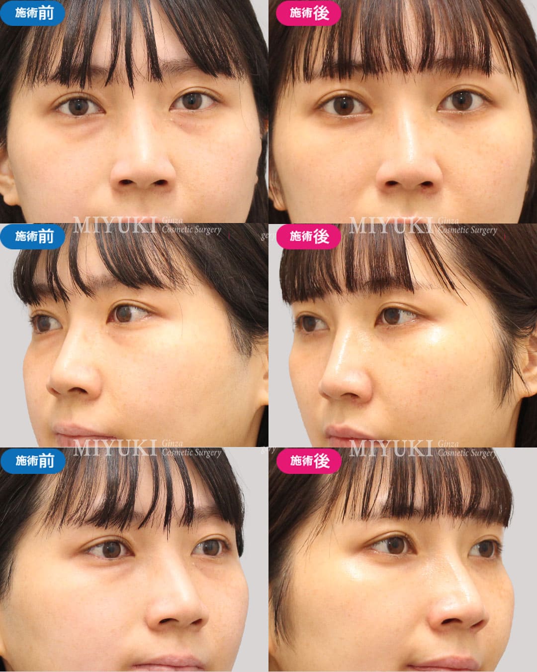 目の下のくま症例468の治療画像