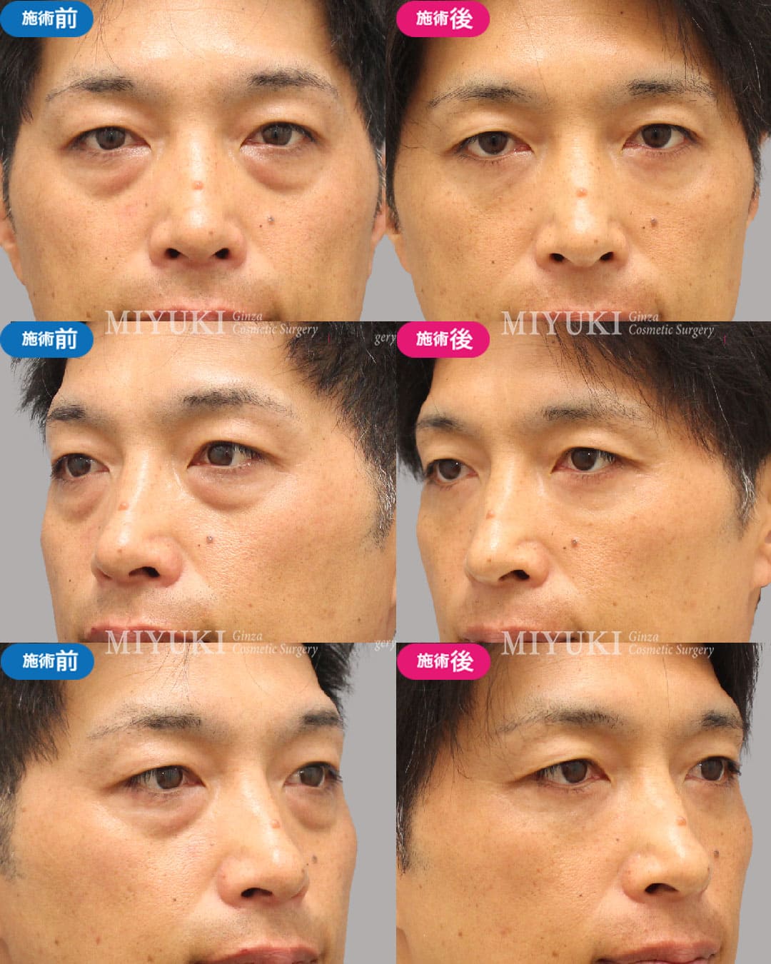 目の下のくま症例469の治療画像